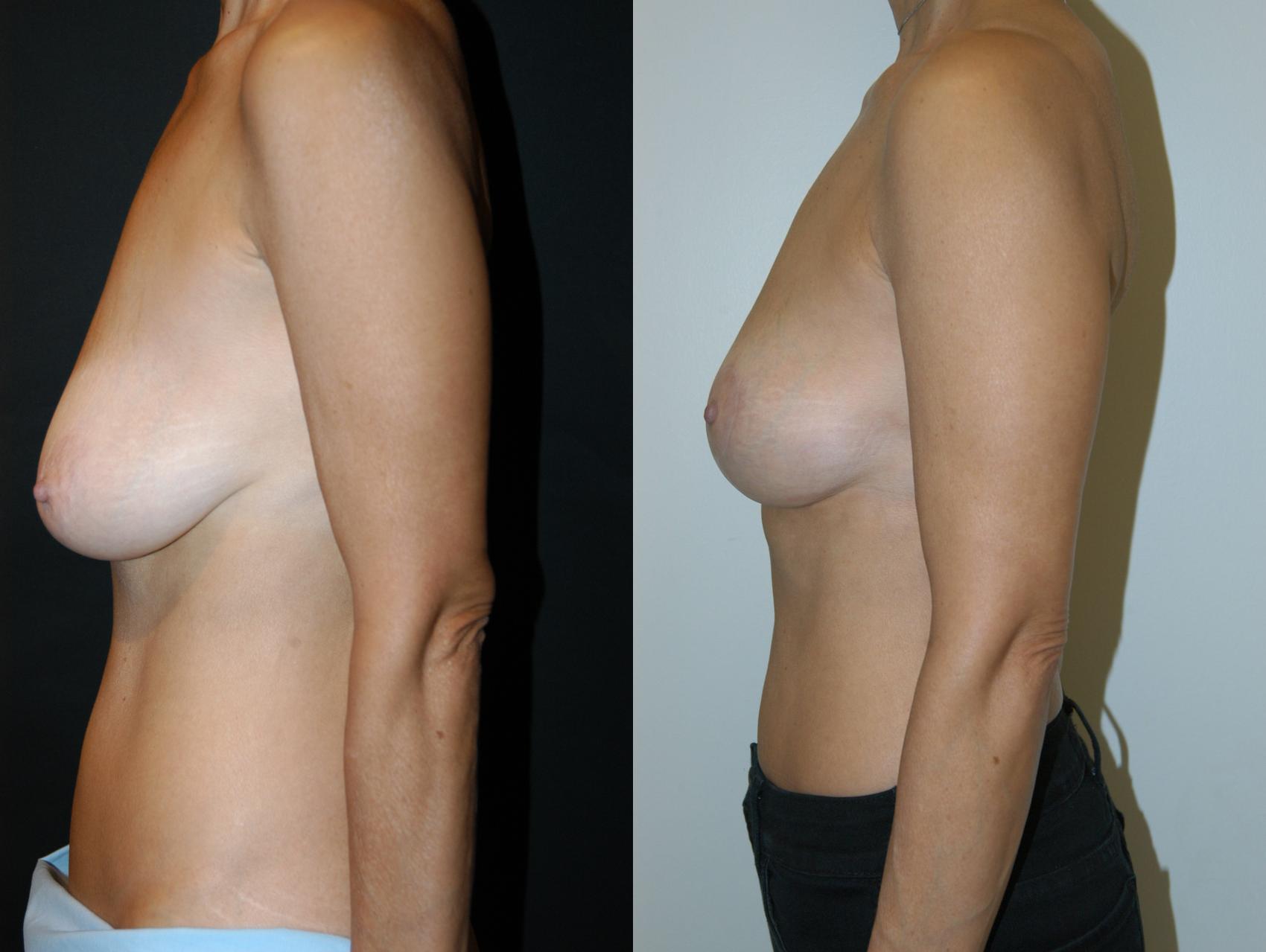 Breast Lift Case 26 Before & After View #3 | Vancouver, BC | Dr. Peter Lennox