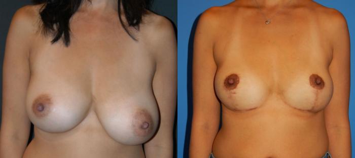 Before & After Breast Lift Case 29 View #1 View in Vancouver, BC