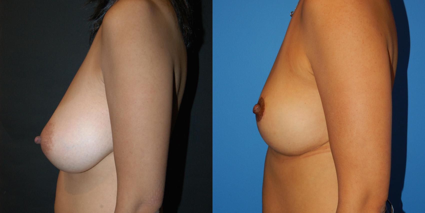 Breast Lift Case 29 Before & After View #2 | Vancouver, BC | Dr. Peter Lennox