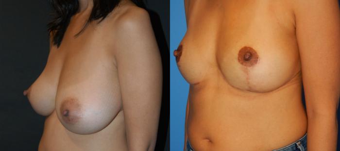 Before & After Breast Lift Case 29 View #3 View in Vancouver, BC