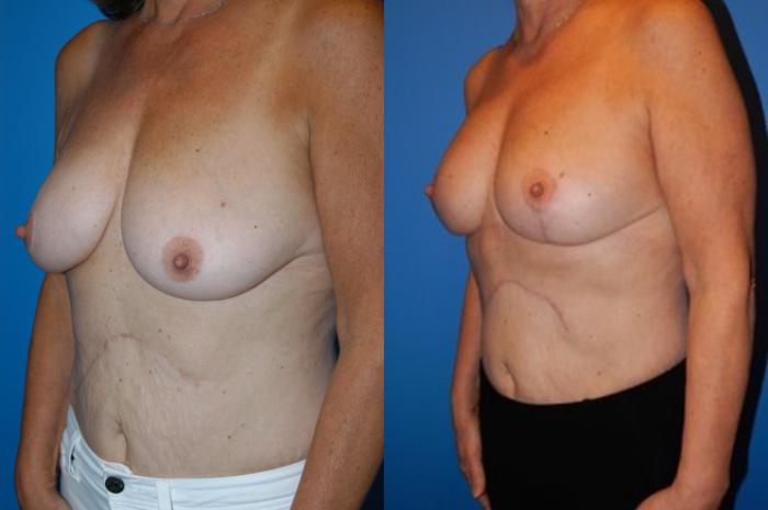Before & After Breast Lift Case 31 View #1 View in Vancouver, BC