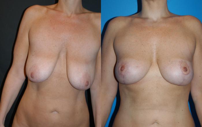 Before & After Breast Lift Case 33 View #1 View in Vancouver, BC