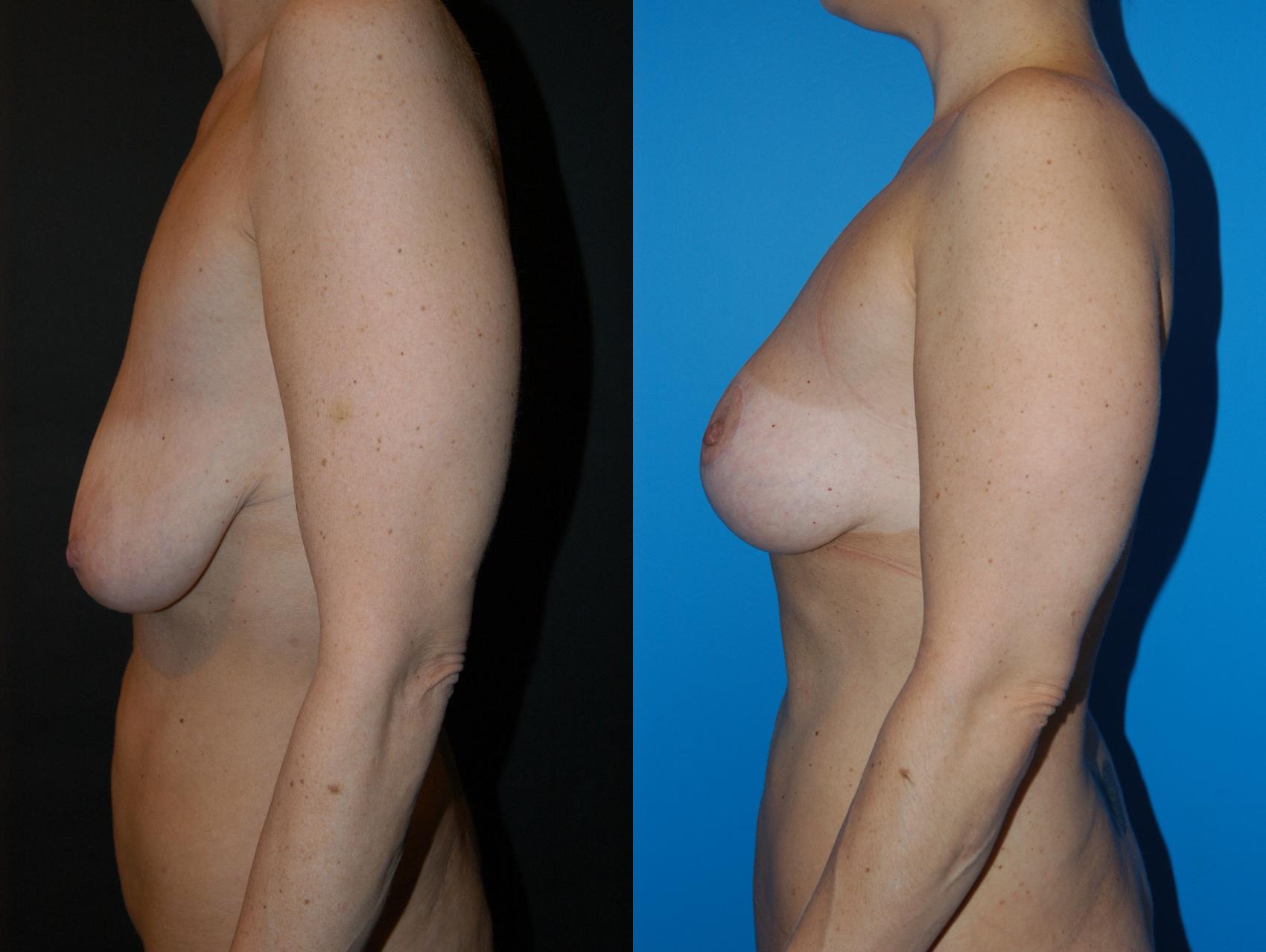 Breast Lift Case 33 Before & After View #2 | Vancouver, BC | Dr. Peter Lennox