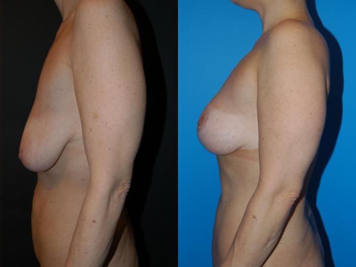 Before & After Breast Lift Case 33 View #2 View in Vancouver, BC