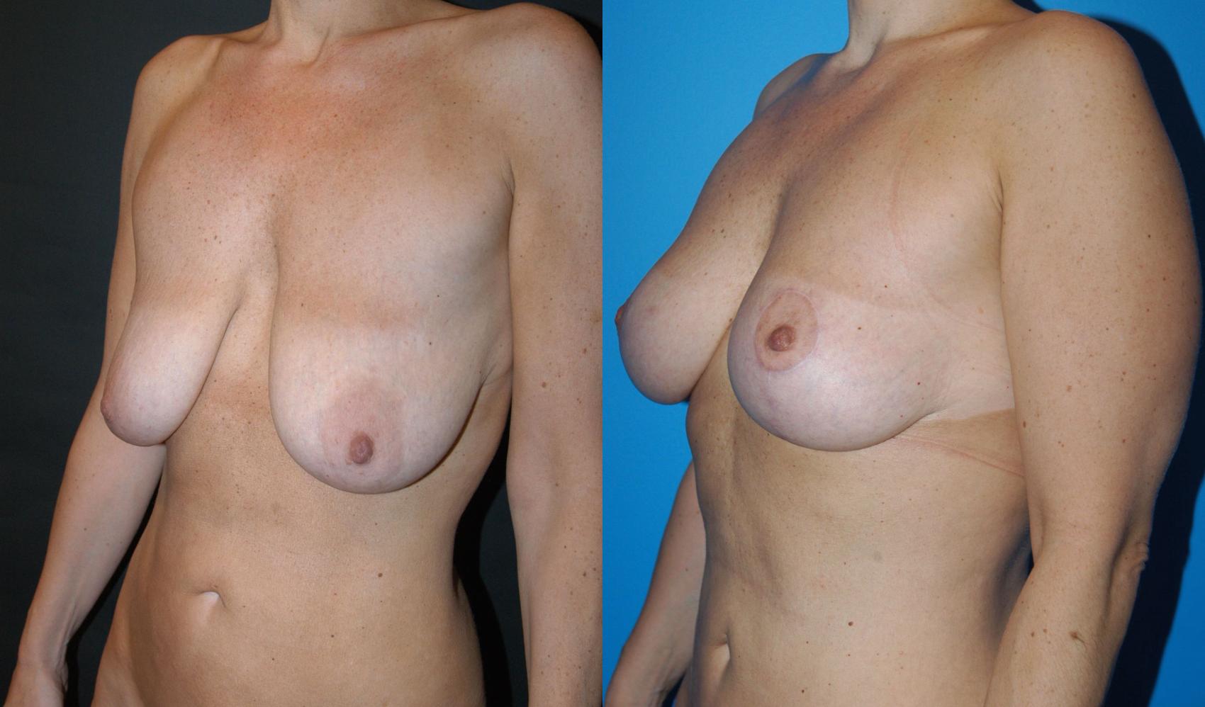 Breast Lift Case 33 Before & After View #3 | Vancouver, BC | Dr. Peter Lennox