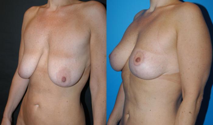 Before & After Breast Lift Case 33 View #3 View in Vancouver, BC