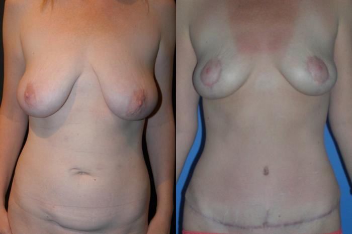 Before & After Breast Lift Case 7 View #1 View in Vancouver, BC
