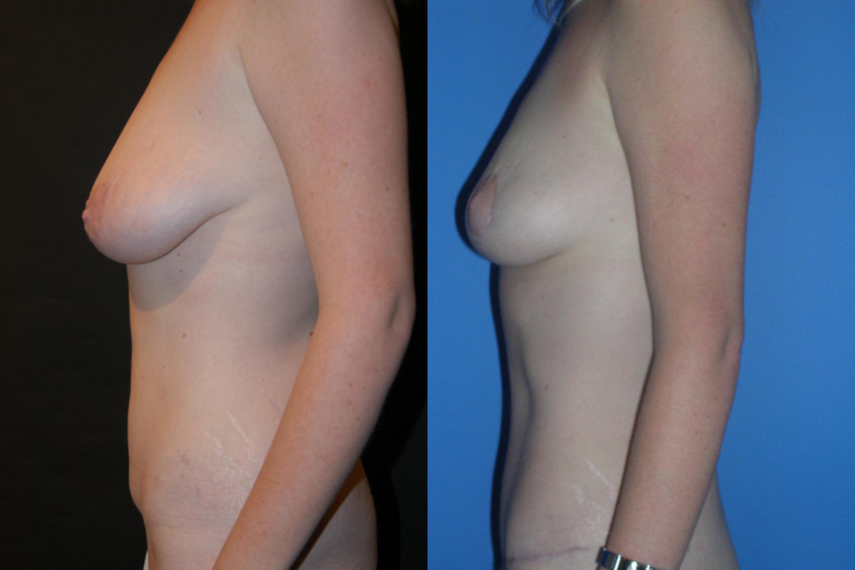 Before & After Breast Lift Case 7 View #2 View in Vancouver, BC