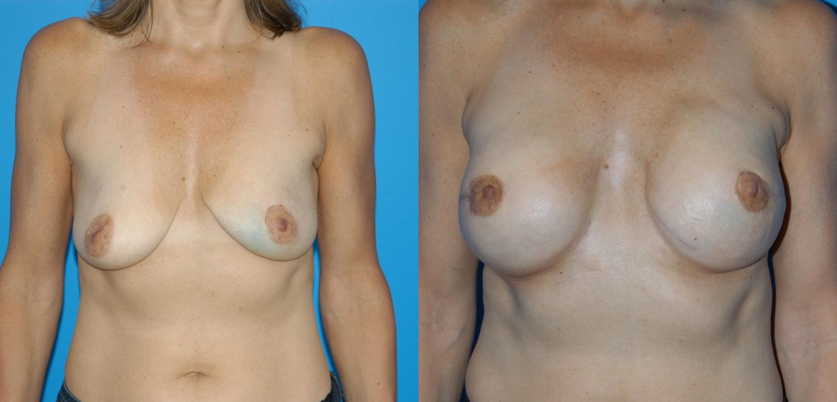 Breast Reconstruction Case 21 Before & After View #1 | Vancouver, BC | Dr. Peter Lennox