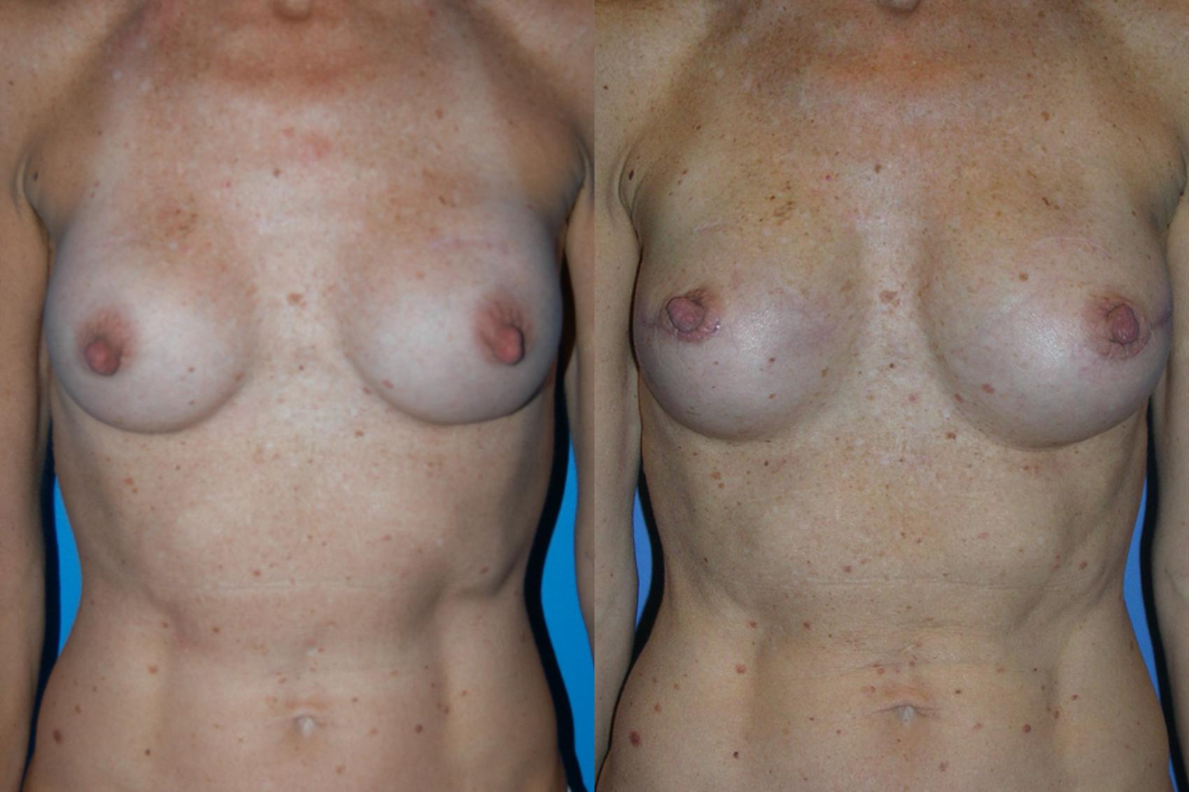 Before & After Breast Reconstruction Case 5 View #1 View in Vancouver, BC