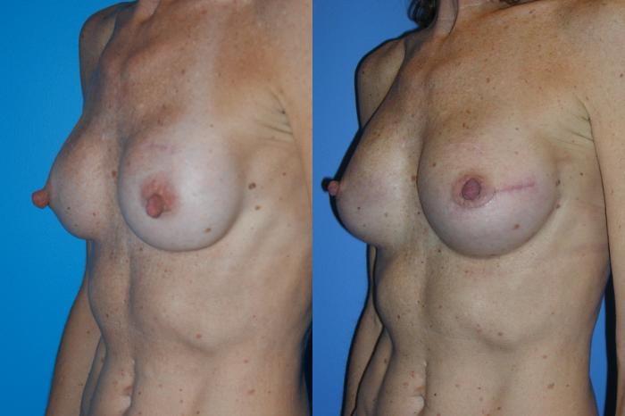 Before & After Breast Reconstruction Case 5 View #2 View in Vancouver, BC