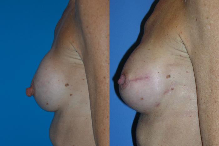 Before & After Breast Reconstruction Case 5 View #3 View in Vancouver, BC