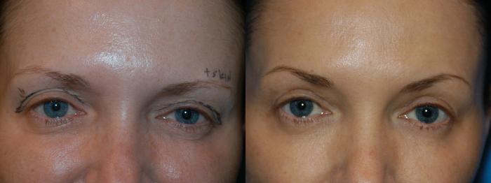 Before & After Eyelid Surgery Case 12 View #1 View in Vancouver, BC