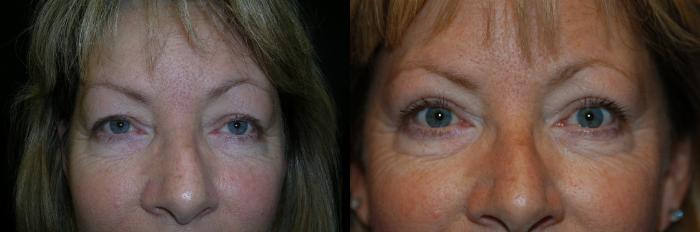 Before & After Eyelid Surgery Case 25 View #1 View in Vancouver, BC