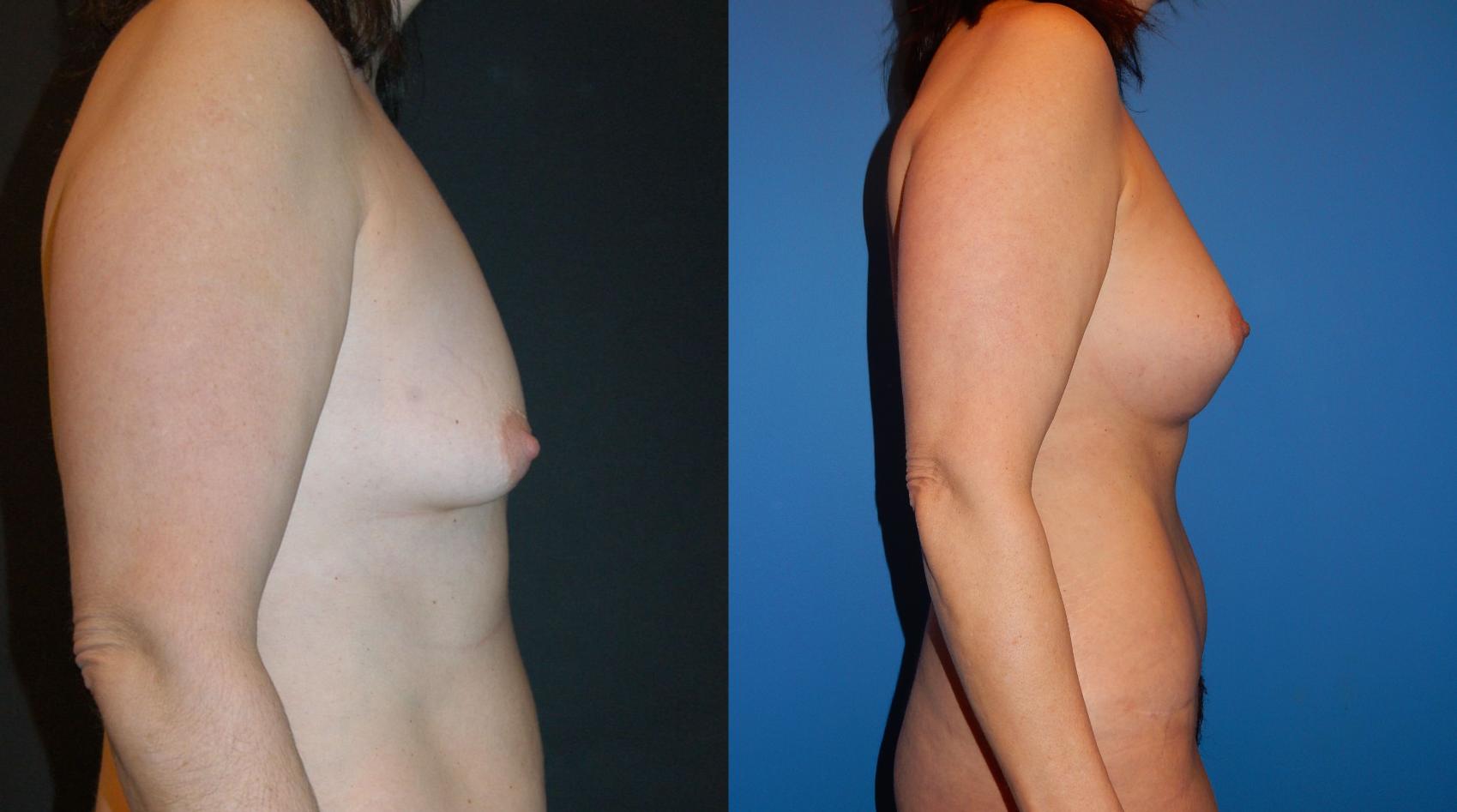 Before & After Mommy Makeover Case 30 View #2 View in Vancouver, BC