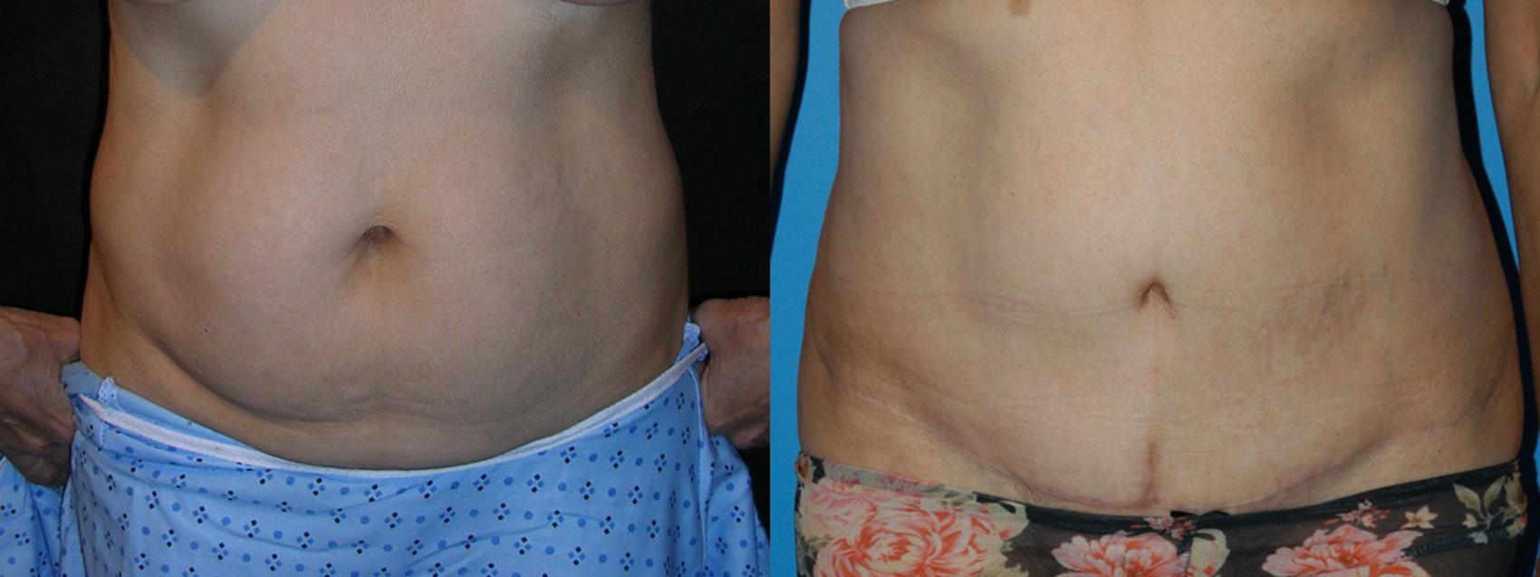 Tummy Tuck Case 15 Before & After View #1 | Vancouver, BC | Dr. Peter Lennox