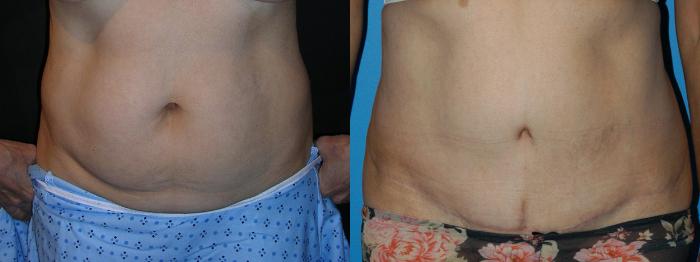 Before & After Tummy Tuck Case 15 View #1 View in Vancouver, BC