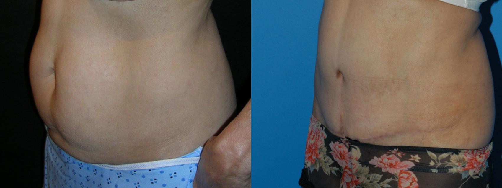 Tummy Tuck Case 15 Before & After View #2 | Vancouver, BC | Dr. Peter Lennox