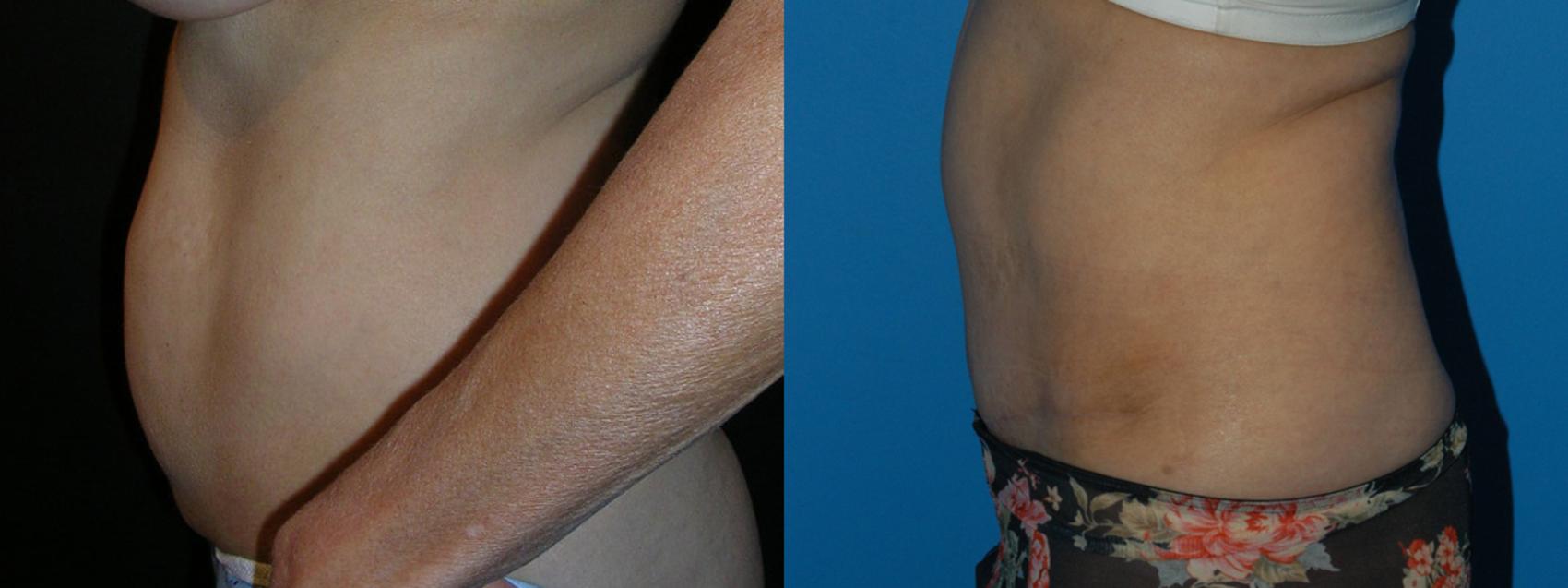 Before & After Tummy Tuck Case 15 View #3 View in Vancouver, BC