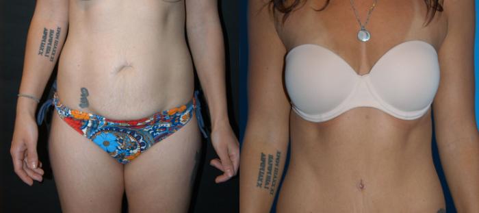 Before & After Tummy Tuck Case 23 View #1 View in Vancouver, BC