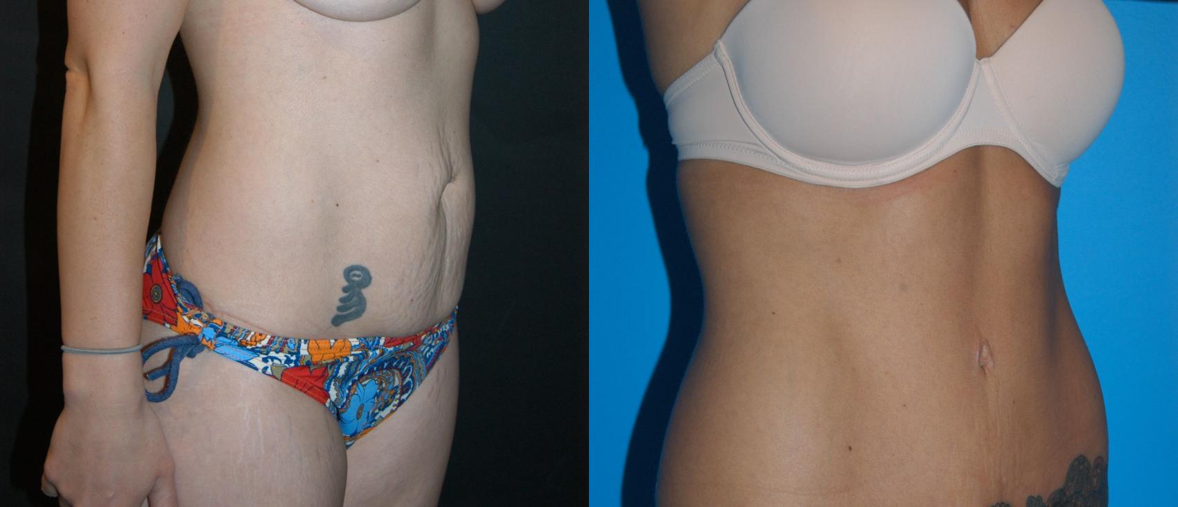 Before & After Tummy Tuck Case 23 View #2 View in Vancouver, BC