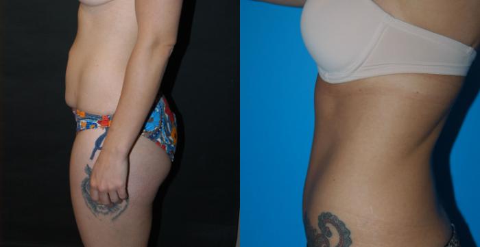 Before & After Tummy Tuck Case 23 View #3 View in Vancouver, BC