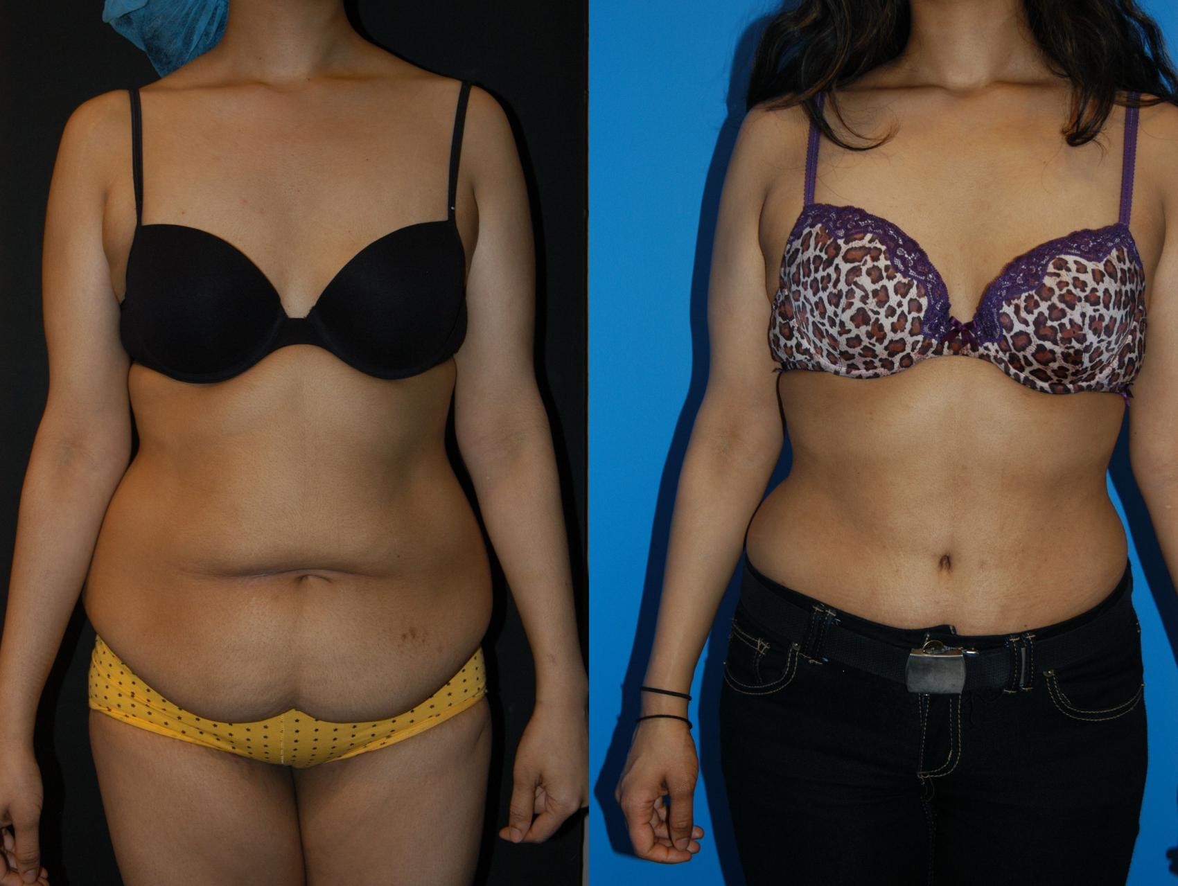 Tummy Tuck (Abdominoplasty) Before and After Photos - Dr Anzarut