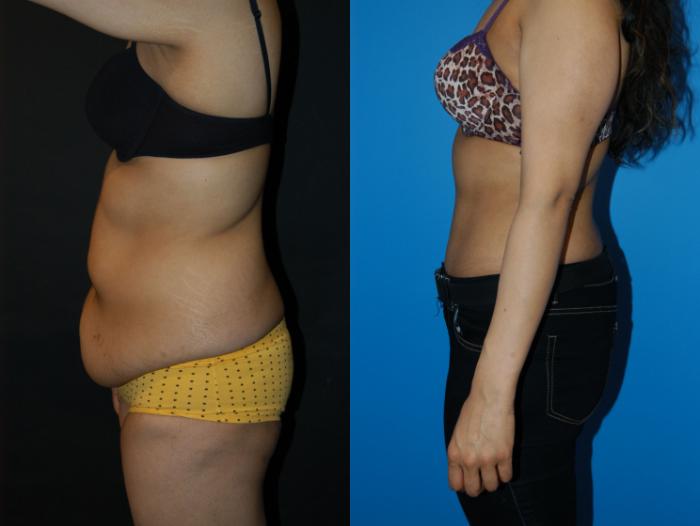 Before & After Tummy Tuck Case 27 View #2 View in Vancouver, BC