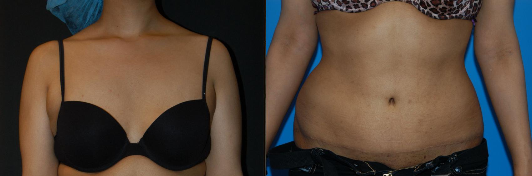 Tummy Tuck Case 27 Before & After View #3 | Vancouver, BC | Dr. Peter Lennox