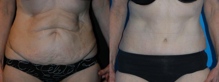 Before & After Tummy Tuck Case 8 View #1 View in Vancouver, BC