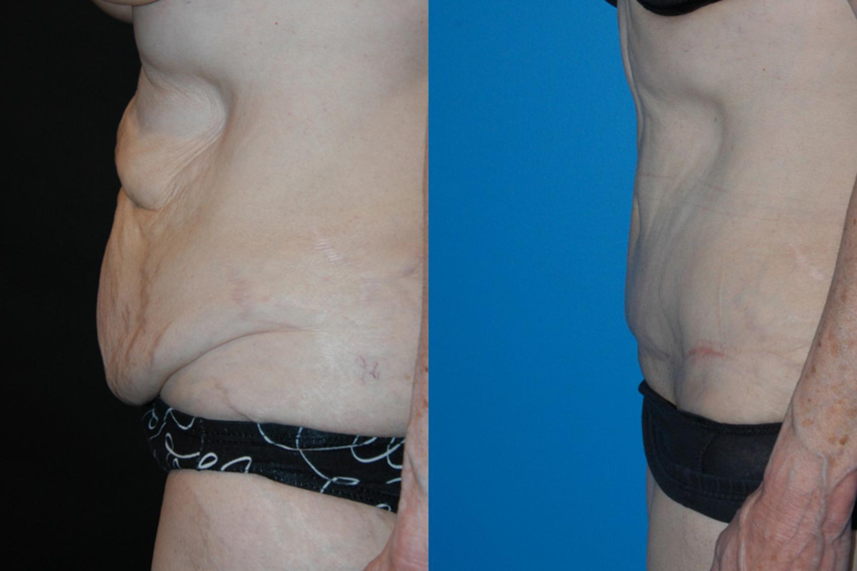 Before & After Tummy Tuck Case 8 View #2 View in Vancouver, BC